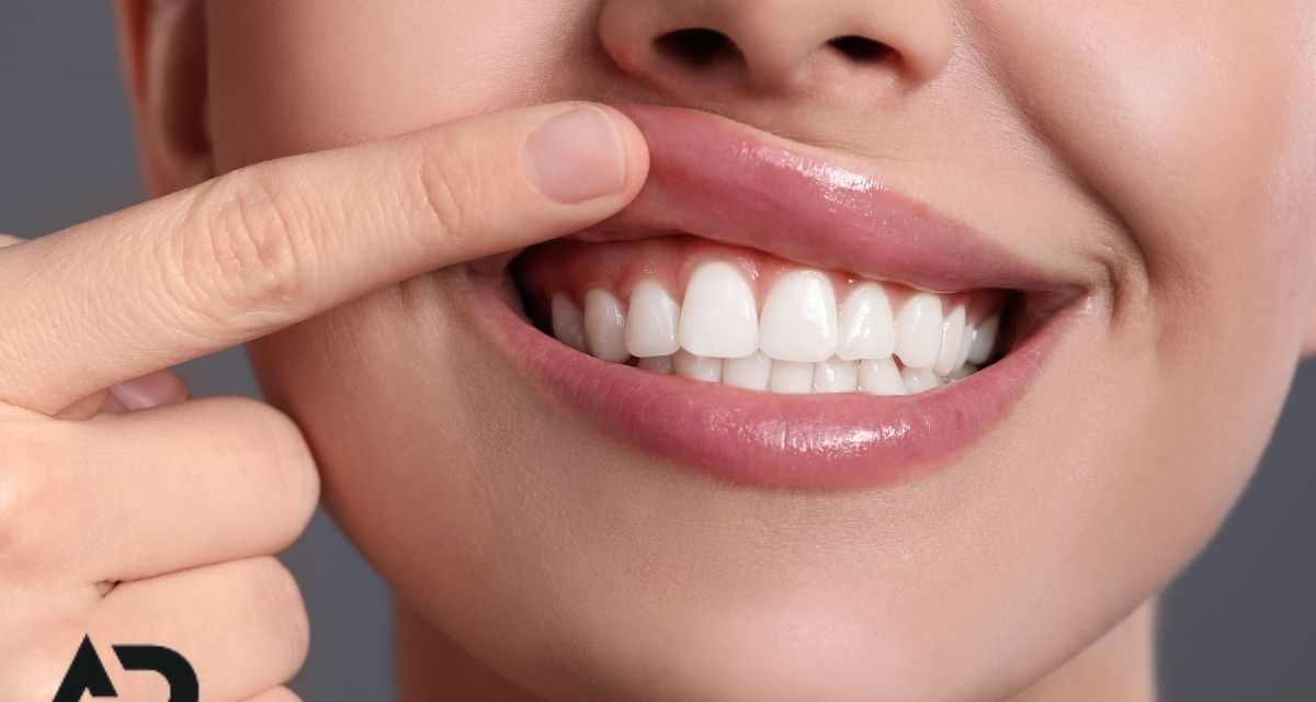 Diş Eti Hastalıkları Nedir? Belirtileri Ve Tedavi Yöntemleri
