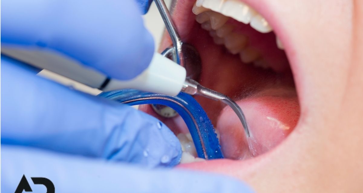 Diş Taşı Temizliği: Malatya DentAP Grup Ağız ve Diş Sağlığı Polikliniği ile Profesyonel Çözümler