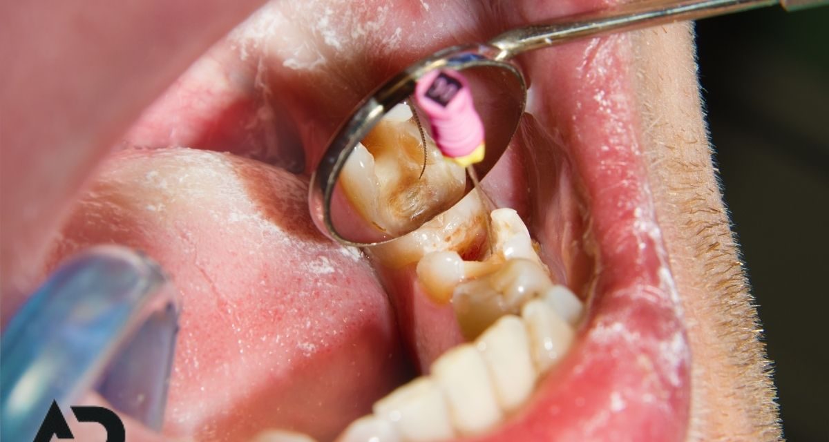 Kanal Tedavisi Sonrasında Dikkat Edilmesi Gerekenler Nelerdir?