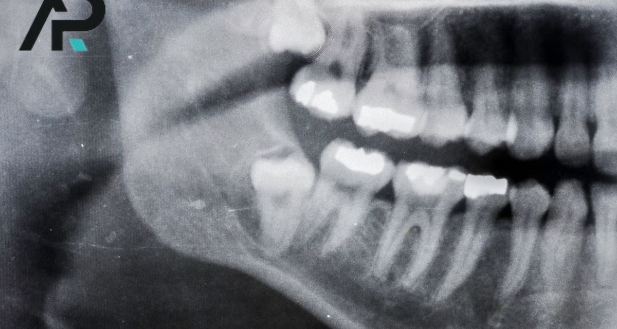 Gömülü Diş Nedir? Belirtileri, Nedenleri ve Tedavi Yöntemleri