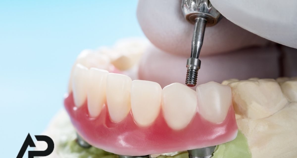 Overdenture Protez Nedir? Kimler İçin Uygundur? Avantajları Nelerdir?