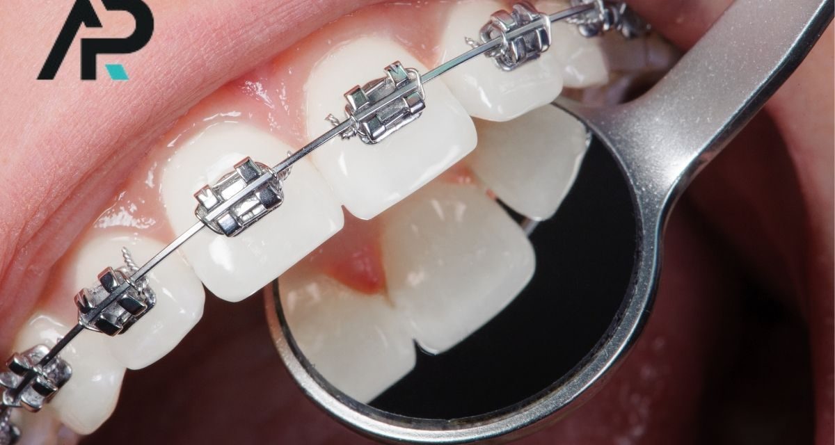 Malatya Ortodonti Tedavisi: Sağlıklı ve Estetik Gülüşler İçin Doğru Adres DentAP Grup