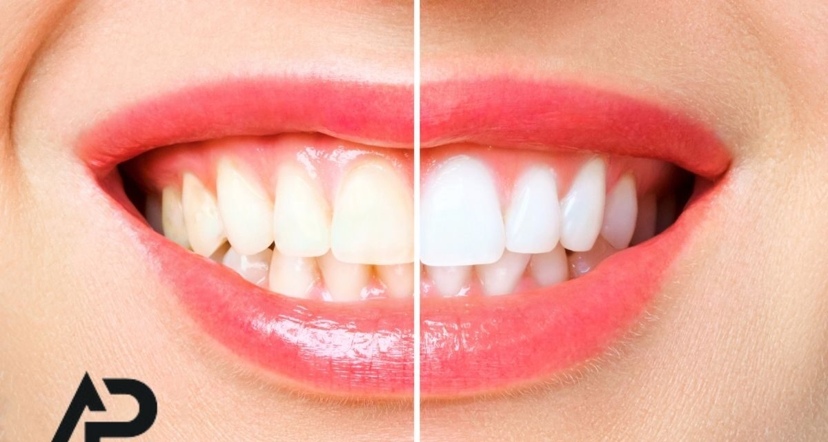 Malatya ve Elbistan’da Diş Beyazlatma Uygulamaları